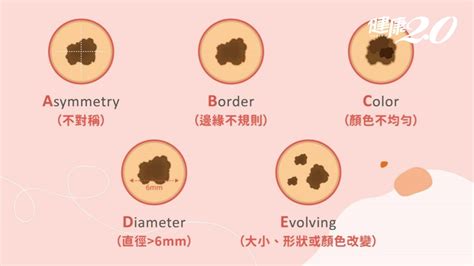 痣 斑|別把癌當黑痣、黑斑！不同階段黑色素癌治療原則一次。